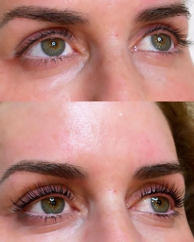 🌟 Lash Lift Transformation! 🌟

Say goodbye to mascara and hello to beautifully lifted lashes with our Lash Lift treatment! ✨✨

Check out this stunning before and after of our much-loved Lash Lift treatment! 😍 

With this treatment, we straighten your natural lashes at the root, giving them a longer, lifted, and voluminous appearance that lasts for 6-8 weeks. No extensions, no adhesive, just gorgeous lashes! 💖

Our Lash Lift is perfect for enhancing what you already have, whether your lashes are long, short, thick, or stubborn. It's a low-maintenance way to achieve a natural-looking eyelash enhancement that makes your eyes appear more open and youthful. Plus, it saves you time in your morning routine! ⏰

Ready to give your lashes some TLC? Book your Lash Lift appointment today, by visiting the link in our bio or call us on 01625 877875. ✨💫

#serenitypoynton #poynton #skinclinic #cheshire #lashlift